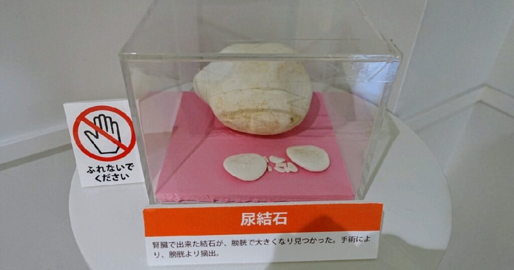膀胱から手術で摘出された大きな尿結石